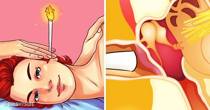 Lấy ráy tai bằng lửa: Điều này khá phổ biến ở một số nước như Trung Quốc, Ai Cập… với tên gọi ear-candling. Theo một nghiên cứu đăng trên tạp chí y học Laryngoscope (Mỹ), ear-candling không thể hút hết ráy tai ra bằng áp lực của lửa. Một khảo sát từng thực hiện với dịch vụ này cho thấy, 10% bệnh nhân từng dùng ear-candling đã bị phỏng nhẹ bên ngoài tai, bị sáp đèn cầy chảy vào trong tai và có trường hợp bị sây sát màng nhĩ.