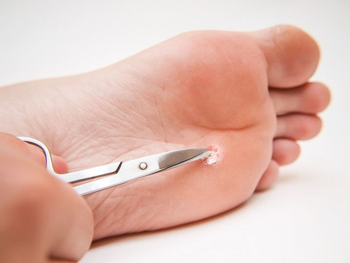 Cắt mụn cóc: Một số người sử dụng kéo, dao hoặc các dụng cụ sắc nhọn khác để cắt đứt mụn cóc. Bạn không nên làm điều đó vì sẽ gián tiếp khiến vết thương bị nhiễm trùng. Có những phương pháp tại nhà an toàn hơn khi xử lý mụn cóc chẳng hạn như lá tía tô, tỏi, chuối hay giấm táo.