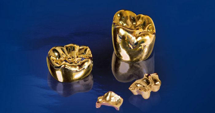 Bên cạnh đó, một số đại gia còn muốn đúc vàng nguyên khối bên trong chân răng. Ảnh minh hoạ