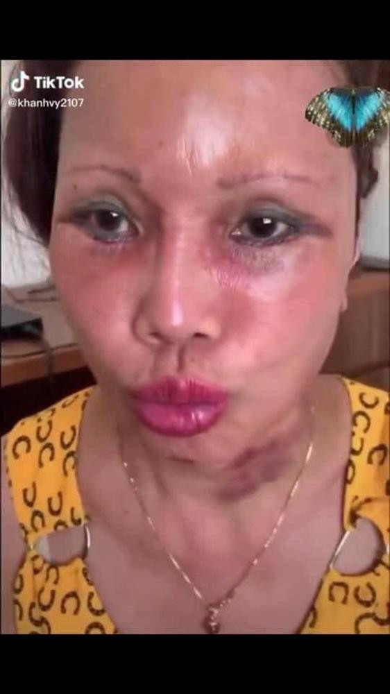 Trong lần chỉnh sửa này, cô dâu Thu Sao quyết định đại phẫu kéo căng da mặt, phải nói đây là một quyết định khá táo bạo ở độ tuổi của chị bởi không chỉ đau đớn mà nó còn khá nguy hiểm vì chị đã lớn tuổi.