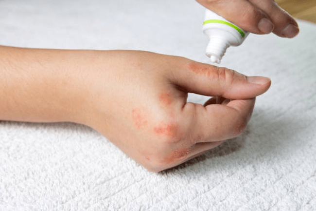 Còn việc bị kiến ba khoang ''đốt'' thực chất là con người dính nọc độc của kiến ba khoang do vô tình đè bẹp nó hoặc cố tình giết chết nó, dẫn đến việc nọc độc trong cơ thể kiến tiếp xúc với da gây đau rát ngứa ngáy. Nói chính xác thì nạn nhân chính là con kiến, còn con người chẳng qua là nạn nhân của chính mình.