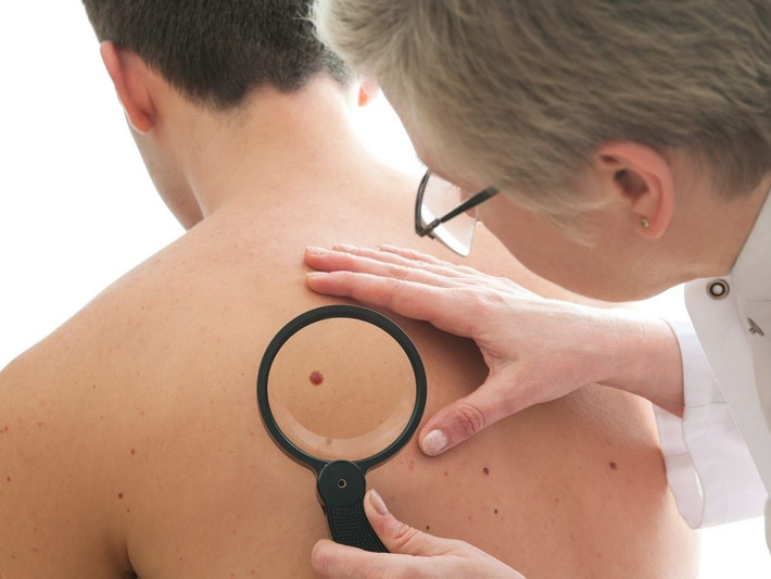 Thay đổi da rõ ràng: Theo Webmd, Tổ chức Ung thư Da Mỹ cho biết các dấu hiệu cảnh báo ung thư trên da bao gồm nốt ruồi đen, lớn hoặc nhô lên; đốm, tàn nhang có hình dạng bất thường, sẫm màu... Nghiên cứu cho thấy nam giới dành nhiều thời gian dưới ánh nắng mặt trời hơn phụ nữ và ít bôi kem chống nắng hơn. Ngoài ra, họ cũng có ít tóc che phủ da đầu và tai - 2 khu vực có xu hướng phát triển ung thư. Ngoài ra, thông thường, đàn ông đến gặp bác sĩ ít hơn phụ nữ, vì vậy, bệnh ung thư của họ có thể không được phát hiện sớm. Ảnh: Thesun.