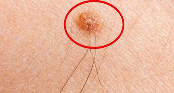 Nếu người nào có trên 3 sợi lông mọc trên nốt ruồi thì chắc chắn người đó có tướng đại phú đại quý, cả đời chẳng bao giờ phải lo thiếu thốn, cứ hết tiền lại có tiền., đặc biệt là về hậu vận. Chính vì vậy, nếu có lông trên nốt ruồi thì tuyệt đối không nên nhổ đi.