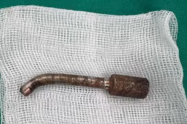 Phẫu thuật cấp cứu lấy mũi khoan cắm sâu trong hốc mũi nam thanh niên