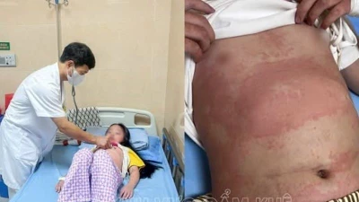 Xuất hiện nhiều trẻ mắc bệnh ban nhiễm khuẩn