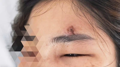 Nặn mụn trên trán, thiếu nữ 32 tuổi viêm mô tế bào nguy kịch