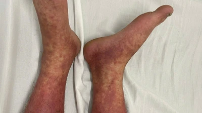 Cảnh báo khẩn, thuốc cấm Phenylbutazone bán tràn lan, nhiều người nguy kịch