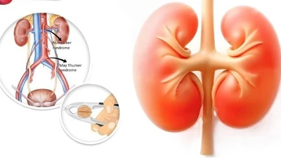 Đi khám vì sụt cân, bé trai được phát hiện Hội chứng kẹp hạt dẻ