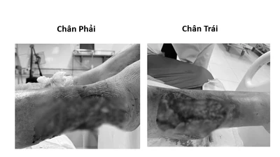 Suýt mất chi vì chủ quan lóc da cẳng chân do tai nạn
