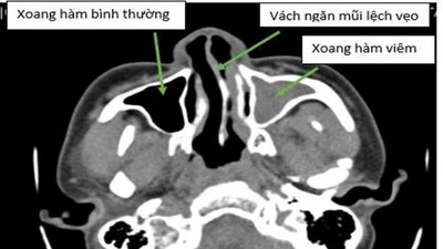 Đau đầu, nghẹt thở... do vẹo vách ngăn mũi