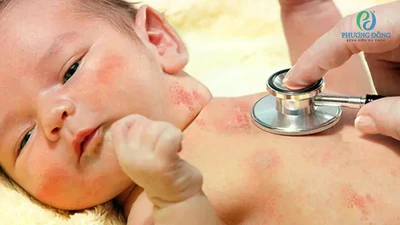 Lây thủy đậu từ mẹ, trẻ sơ sinh suy hô hấp cấp nguy kịch