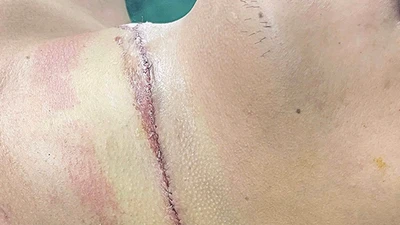 Bị dây thép trên đường cứa ngang cổ nguy kịch khi đi xe máy
