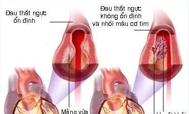 Đau thắt ngực theo chu kỳ có phải tổn thương động mạch vành?