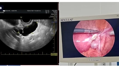 Đau hạ vị kéo dài không ngờ ứ mủ vòi trứng, viêm phúc mạc