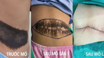 Mổ 2 lần lấy khối u sắc tố bẩm sinh khổng lổ cho trẻ 8 tuổi