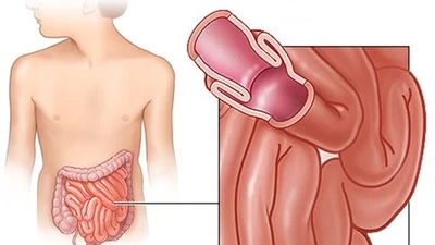 Đau bụng và khóc, trẻ 1 tuổi lồng ruột nguy kịch