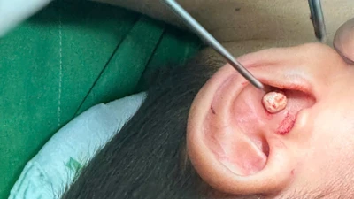 Trẻ 5 tuổi nhét sỏi vào tai, đi hai bệnh viện mới lấy được