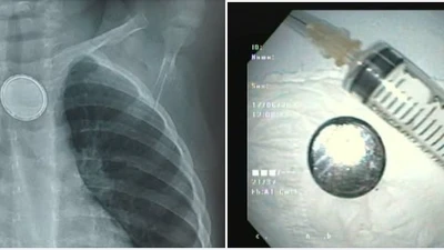 Dị vật cực nguy hiểm gây loét thực quản trẻ 18 tháng