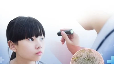Trẻ 8 tuổi suy giảm thị lực nghiêm trọng vì giun đũa chó mèo trong mắt