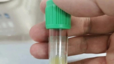 Viêm tụy cấp do không tuân thủ điều trị đái tháo đường