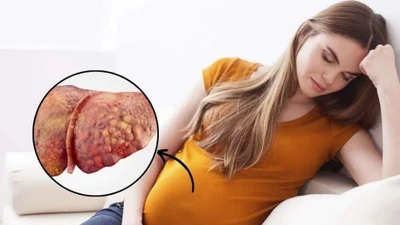 Thay máu toàn cơ thể cứu thai phụ gan nhiễm mỡ cấp tính nặng