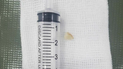Trẻ ho sốt, không ngờ hạt lạc trong phế quản gốc trái