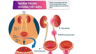 Bí quyết "vàng" ngăn ngừa nhiễm khuẩn tiết niệu