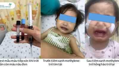 Bé gái tím tái, nguy kịch sau khi ăn ghẹ, rau nấu nước giếng