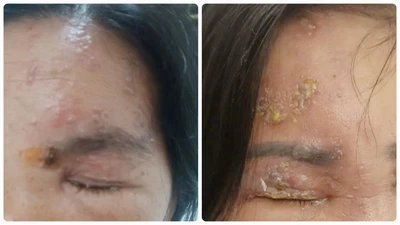 Đối tượng cần tiêm vắc xin Zona tránh biến chứng nặng