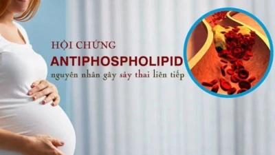 Mang thai mắc hội chứng kháng phospholipid ảnh hưởng gì?