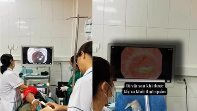 Đau nhói thực quản sau ăn do dị vật xương cá mắc tại cổ