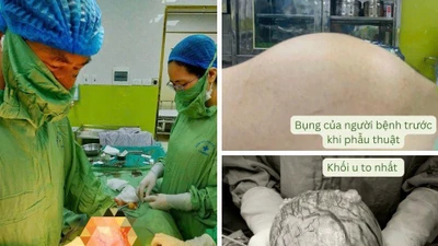Đa u xơ tử cung kích thước lớn do dùng thực phẩm chức năng