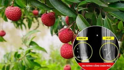 Trèo cây hái vải, người đàn ông bị ngã đa chấn thương