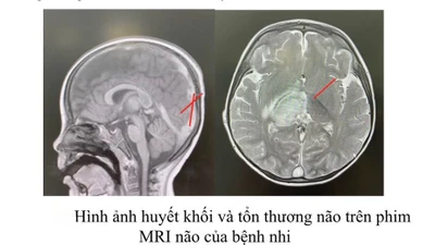 Nôn ói sau ăn, bé trai phát hiện huyết khối tĩnh mạch nội sọ