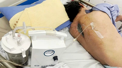 Thoát liệt nhờ phát hiện nhiễm nấm tại vết mổ cột sống ngực