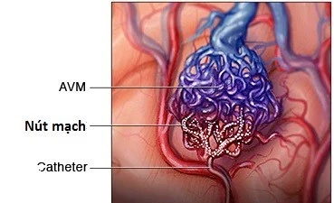 Địa chỉ vàng: Bệnh viện ở Hà Nội can thiệp dị dạng mạch máu
