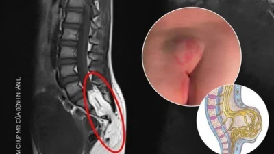 10 tuổi bỗng nhiên đái dầm đi khám không ngờ dị tật tủy sống