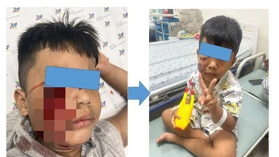 Bé 5 tuổi bị chó cắn hàng chục vết thương sâu ở mặt
