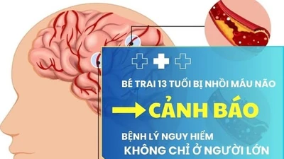 Đang khỏe mạnh, bé trai 13 tuổi đột ngột nhồi máu não