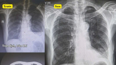 Cứu sống ngoạn mục cụ ông 96 tuổi chấn thương nặng do ngã