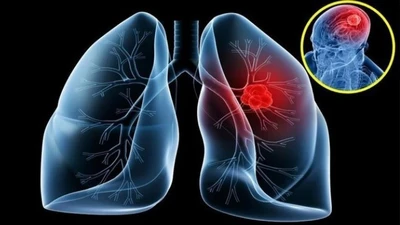 Ung thư phổi di căn não nguy hiểm thế nào?