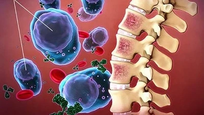 Nhận biết sớm bệnh xơ tủy ác tính nguy hiểm