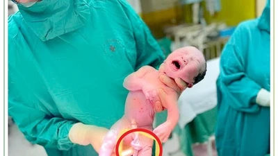 Hiếm gặp trẻ có dây rốn dài 1m, xoắn vặn nhiều vòng