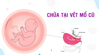 Chửa trên vết mổ cũ, thai vỡ máu tràn ổ bụng nguy kịch