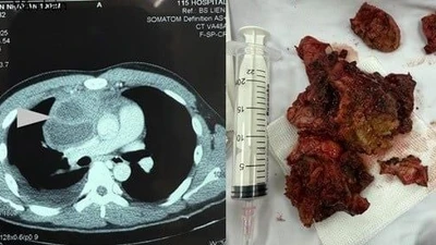 Đau lưng, bả vai, thanh niên 20 tuổi phát hiện u quái trung thất lớn