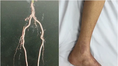 Phẫu thuật bắc cầu mạch chi cứu đôi chân cụ ông 84 tuổi