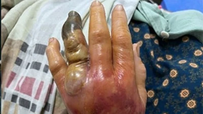 Bàn tay của bệnh nhân