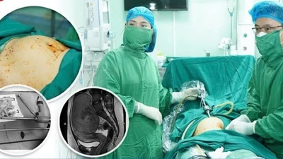 3 năm không chữa, u xơ tử cung phát triển như thai 4 tháng
