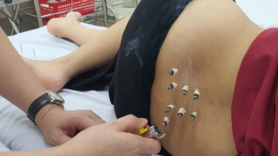 Nhiều sản phụ bí tiểu sau sinh, cách gì khắc phục?