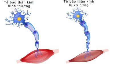 Xơ cột bên teo cơ, khi cơ thể dần “quên” cách vận động